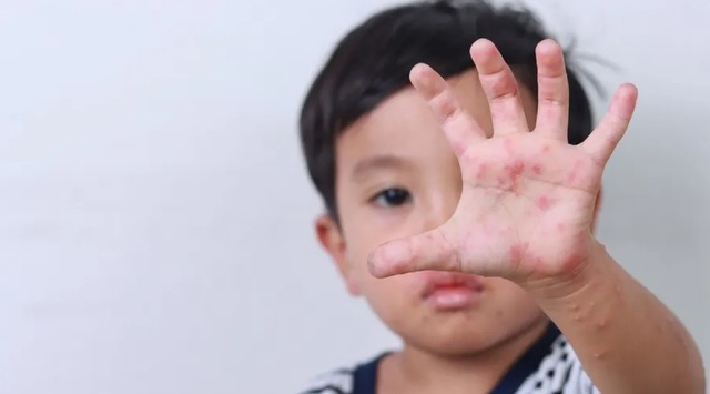 Vì sao bệnh tay chân miệng tăng mạnh ở trẻ mầm non vào đầu tuần?- Ảnh 1.