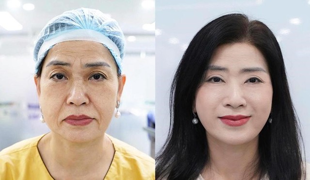 Căng da mặt - khi trẻ hóa không còn là 'kéo da' đơn thuần- Ảnh 2.