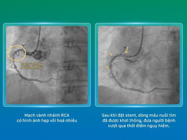 Bệnh viện Phương Đông: Nghẹt thở khơi thông 3 nhánh mạch vành hẹp khít, giành lại dòng máu nuôi tim cho bệnh nhân 72 tuổi- Ảnh 2.