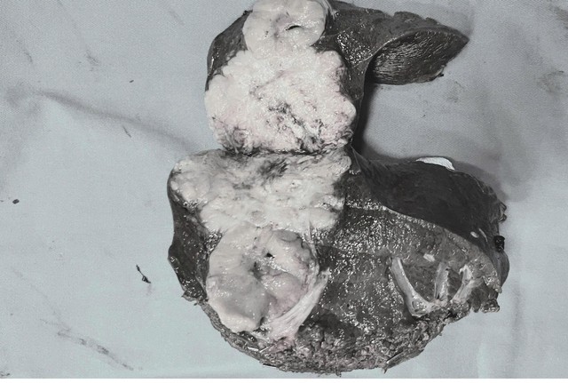 Nội soi cắt ung thư gan nặng 400g ở bệnh nhân viêm gan B- Ảnh 1.