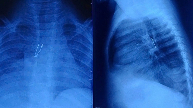 Bé 9 tháng tuổi sặc bóng đèn LED, nhập viện nguy kịch- Ảnh 1.