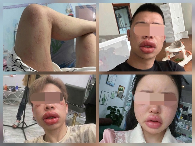 Sưng mắt, môi sau khi ăn bánh trứng kiến: Đặc sản hay 'thủ phạm'?- Ảnh 1.