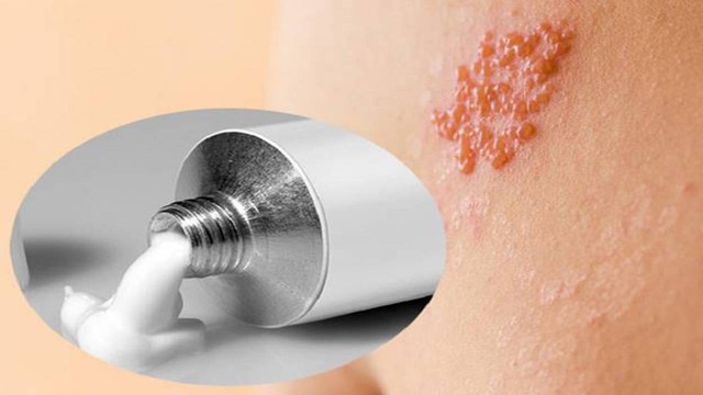 Zona là bệnh có thể kiểm soát tốt nếu được phát hiện sớm và chăm sóc đúng cách.