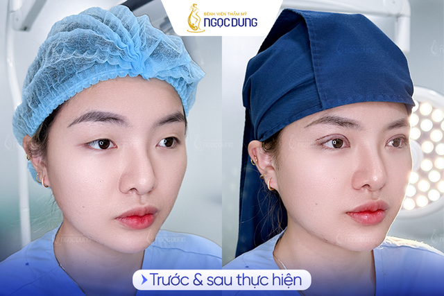 Có nên cắt mí mắt? Phân tích từ chuyên gia- Ảnh 3.