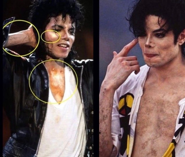 Sự thật về căn bệnh hiếm khiến Michael Jackson phải tẩy trắng da- Ảnh 2.