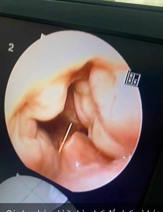 Nhiều trường hợp hóc dị vật đường ăn, chuyên gia khuyến nghị cách xử lý ban đầu- Ảnh 2.