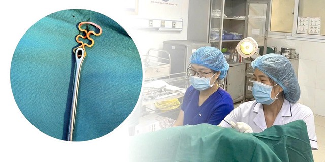 Bỏ quên vòng tránh thai suốt 30 năm, người phụ nữ 63 tuổi gặp biến chứng phụ khoa
- Ảnh 1.
