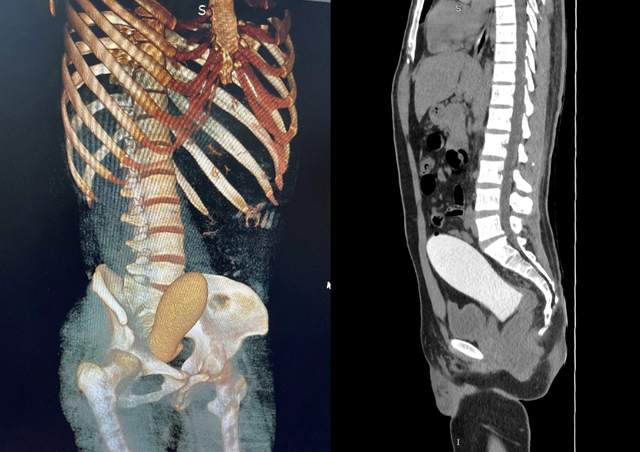 Nam thanh niên phải cấp cứu vì mắc 'trứng rồng' hơn 13cm trong trực tràng khi thủ dâm- Ảnh 1.