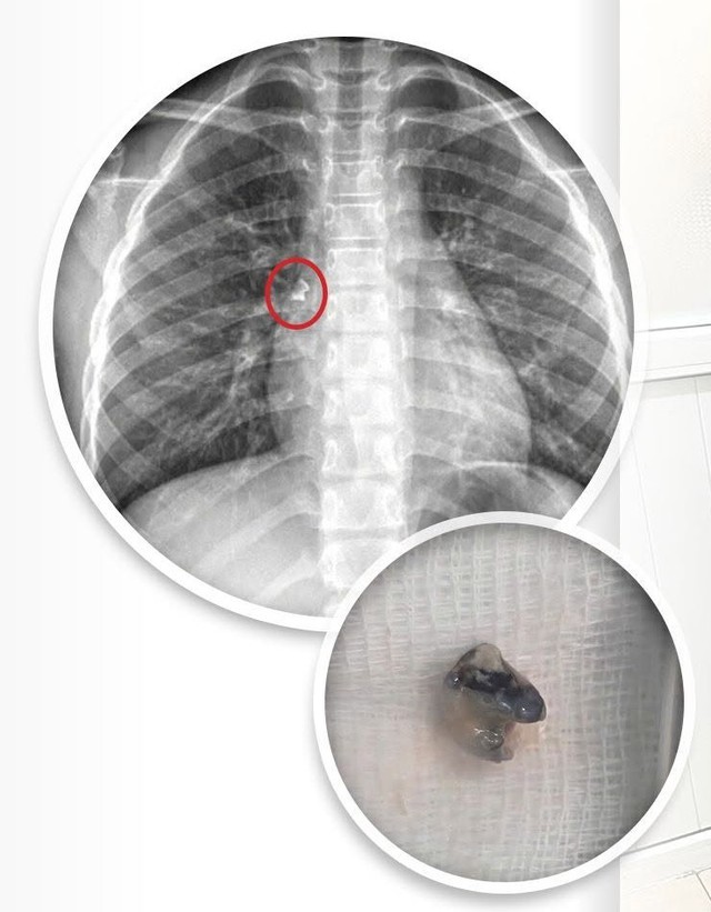 Chiếc răng 'đi lạc' vào phế quản, bé trai 9 tuổi phải nội soi cấp cứu- Ảnh 1. Chiếc răng 'đi lạc' vào phế quản, bé trai 9 tuổi phải nội soi cấp cứu- Ảnh 1.