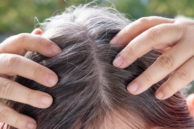 Những bệnh lý tiềm ẩn phía sau dấu hiệu tóc bạc sớm ở người trẻ- Ảnh 1. Những bệnh lý tiềm ẩn phía sau dấu hiệu tóc bạc sớm ở người trẻ- Ảnh 1.