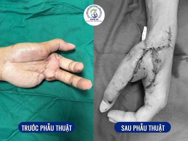 Bước tiến trong phẫu thuật vi phẫu: Chuyển vạt SCIP tự do được triển khai tại Nghệ An- Ảnh 2. Bước tiến trong phẫu thuật vi phẫu: Chuyển vạt SCIP tự do được triển khai tại Nghệ An- Ảnh 2.