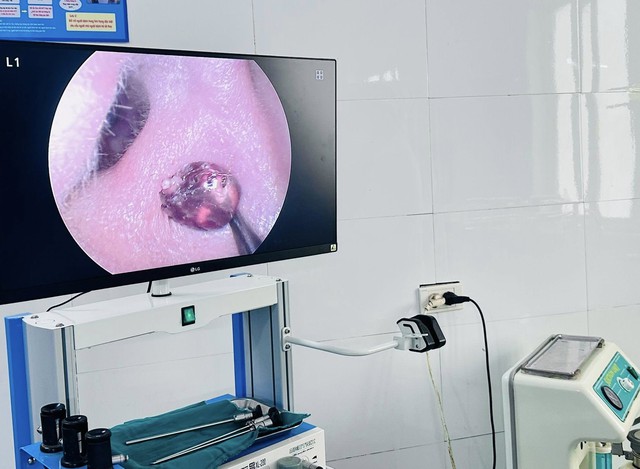 Đau nhức tai suốt một tuần, người phụ nữ tá hỏa vì 'vị khách lạ' trong tai- Ảnh 1. Đau nhức tai suốt một tuần, người phụ nữ tá hỏa vì 'vị khách lạ' trong tai- Ảnh 1.