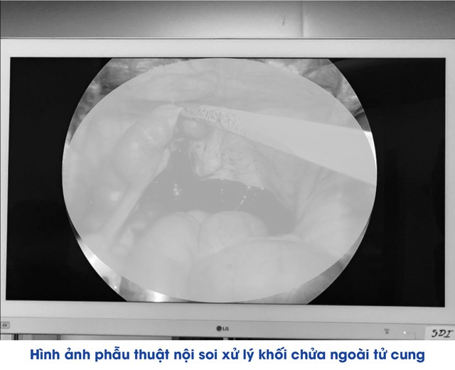 Liên tiếp cứu sống nhiều phụ nữ chửa ngoài tử cung vỡ tại Bệnh viện Đa khoa Khu vực Vân Đồn - Ảnh 2. Liên tiếp cứu sống nhiều phụ nữ chửa ngoài tử cung vỡ tại Bệnh viện Đa khoa Khu vực Vân Đồn - Ảnh 2.