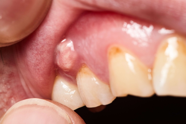 Những biến chứng nguy hiểm do sưng mộng răng có mủ - Ảnh 1.