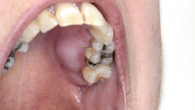 Những biến chứng nguy hiểm do sưng mộng răng có mủ - Ảnh 2.