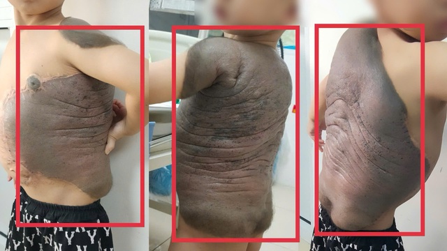 Hành trình phẫu thuật khối u hắc tố tại bệnh viện: Câu chuyện cảm động của bé trai 7 tuổi - Ảnh 2. Hành trình phẫu thuật khối u hắc tố tại bệnh viện: Câu chuyện cảm động của bé trai 7 tuổi - Ảnh 2.