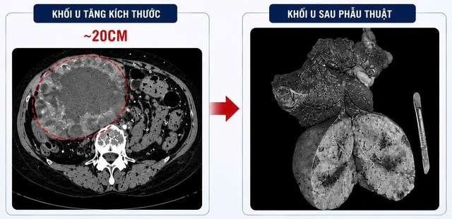 U gan 2 cm 'phình' lên 20 cm do tự điều trị bằng thuốc nam- Ảnh 1. U gan 2 cm 'phình' lên 20 cm do tự điều trị bằng thuốc nam- Ảnh 1.