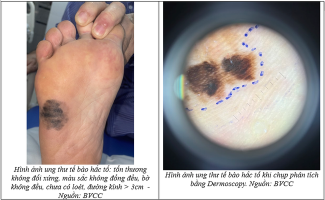 Ung thư da ngày càng nhiều, có người 20 tuổi đã mắc bệnh- Ảnh 2.