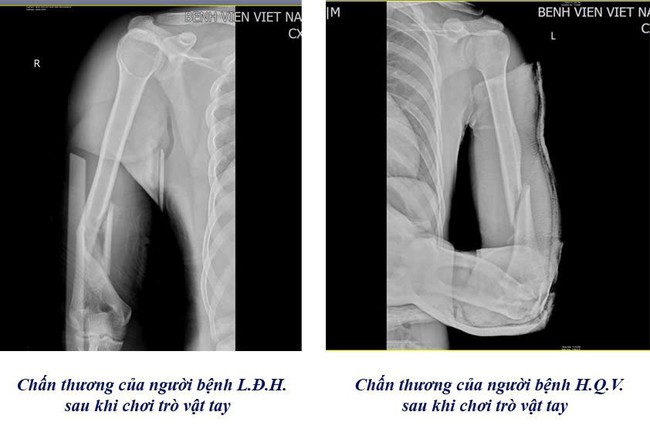 Cảnh báo nguy cơ gẫy xương cánh tay từ trò vật tay- Ảnh 1.