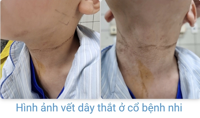 Hi hữu bé trai 5 tuổi nghịch dây giải rút, tự 'thắt cổ' mình- Ảnh 2. Hi hữu bé trai 5 tuổi nghịch dây giải rút, tự 'thắt cổ' mình- Ảnh 2.