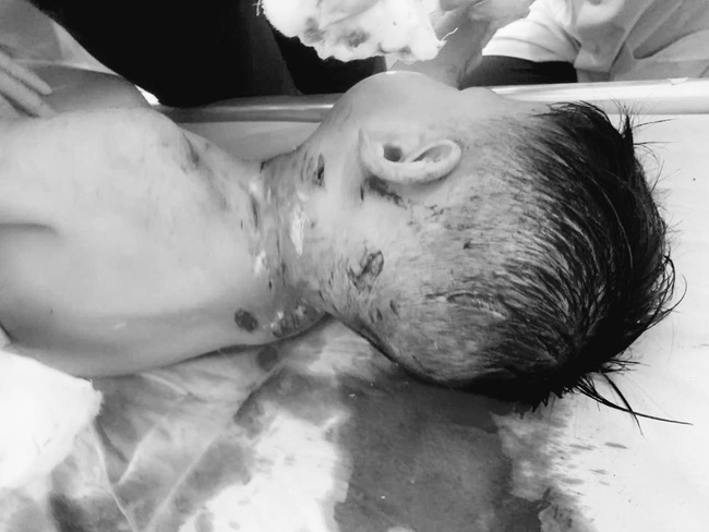 Bé 3 tuổi bị chó nhà hàng xóm cắn đến mức lộ xương sọ, đứt tĩnh mạch- Ảnh 1.