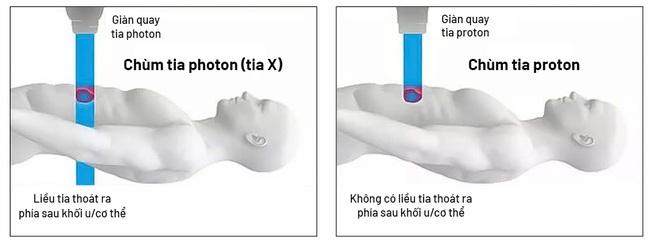 Bệnh viện Tâm Anh chính thức mua 'siêu máy' điều trị ung thư công nghệ proton- Ảnh 3. Xạ trị photon (tia X) đưa liều xạ vào khối u nhưng vẫn có thể “đi xuyên qua” phía sau, có thể gây tổn thương mô lành quanh đường đi của tia; trong khi đó xạ trị proton hiện đại với tia năng lượng biết “dừng đúng chỗ” ngay vị trí khối u để tiêu diệt khối u hiệu quả và an toàn cao.