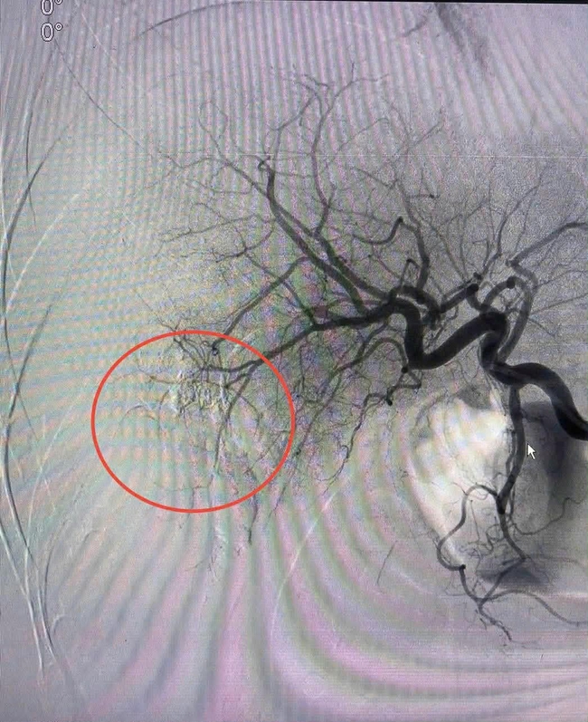 Cứu sống bệnh nhân vỡ gan độ IV bằng kỹ thuật can thiệp nội mạch- Ảnh 4.