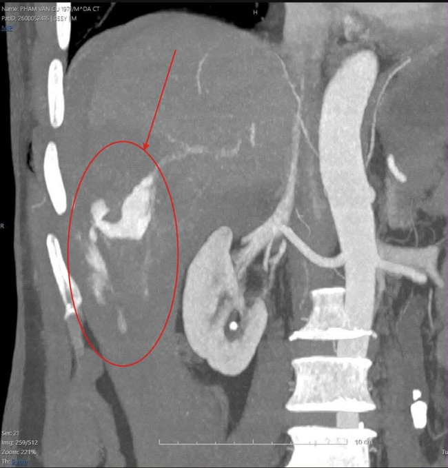 Cứu sống bệnh nhân vỡ gan độ IV bằng kỹ thuật can thiệp nội mạch- Ảnh 2.