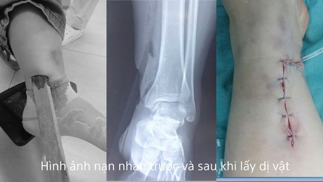 Một phụ nữ bị dị vật cắm sâu vào cẳng chân sau tai nạn giao thông- Ảnh 1.