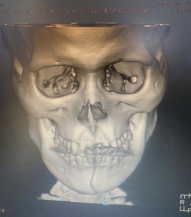 Phẫu thuật thành công ca chấn thương hàm mặt phức tạp tại tuyến cơ sở- Ảnh 1.