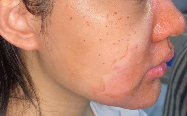 Peel da mặt làm đẹp, cô gái mọc chi chít mụn nước, vỡ chảy dịch- Ảnh 1.
