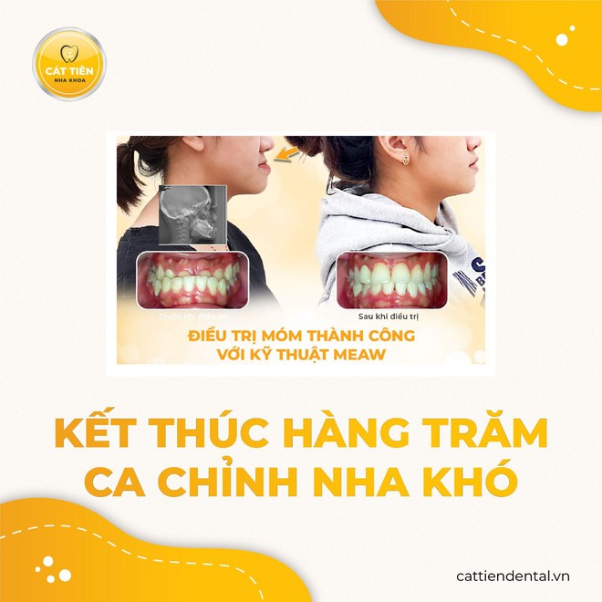 Niềng răng đúng để có nụ cười khỏe mạnh, thẩm mỹ- Ảnh 7.