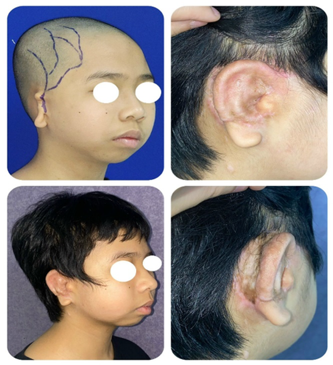 Bé trai 5 tuổi dị tật lép nửa mặt, tai nhỏ được 'trả lại' gương mặt cân đối- Ảnh 1.
