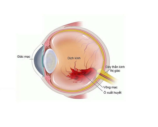 Bệnh lý dịch kính võng mạc: Nguyên nhân thứ hai gây mù lòa- Ảnh 1.