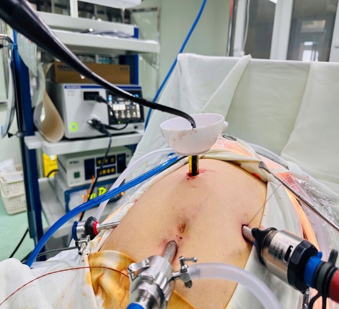 Bệnh viện Hữu nghị Đa khoa Nghệ An tiên phong tán sỏi đường mật bằng điện thủy lực- Ảnh 3. Bệnh viện Hữu nghị Đa khoa Nghệ An tiên phong tán sỏi đường mật bằng điện thủy lực- Ảnh 3.