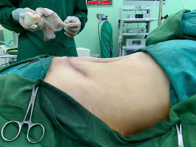Phẫu thuật khối u nang buồng trứng nặng 6kg cho người phụ nữ 56 tuổi- Ảnh 5. Phẫu thuật khối u nang buồng trứng nặng 6kg cho người phụ nữ 56 tuổi- Ảnh 5.