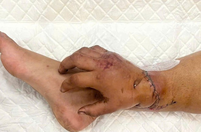 Bác sĩ Võ Thái Trung, BVĐK Bình Dương kể về ca ghép tạm bàn tay vào chân hiếm gặp, cứu mẹ và hai thai nhi- Ảnh 2.