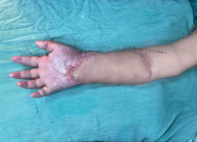 Bác sĩ Võ Thái Trung, BVĐK Bình Dương kể về ca ghép tạm bàn tay vào chân hiếm gặp, cứu mẹ và hai thai nhi- Ảnh 3.