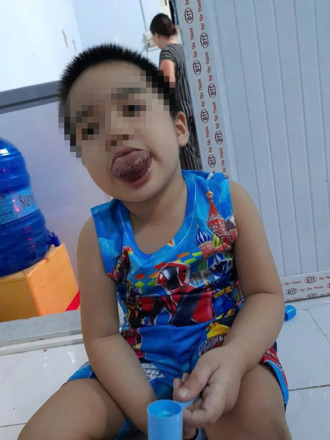 Phẫu thuật thu nhỏ chiếc lưỡi khổng lồ giúp cậu bé 9 tuổi tìm lại nụ cười- Ảnh 1. Phẫu thuật thu nhỏ chiếc lưỡi khổng lồ giúp cậu bé 9 tuổi tìm lại nụ cười- Ảnh 1.