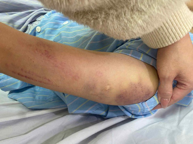 Nữ sinh lớp 7 ở Nghệ An nghi bị bố đánh bầm tím khắp người- Ảnh 2.