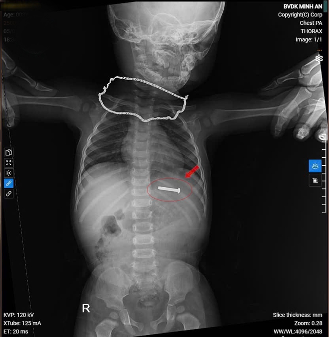 Gắp thành công đinh vít dài 5cm khỏi dạ dày bé trai 15 tháng tuổi- Ảnh 1.