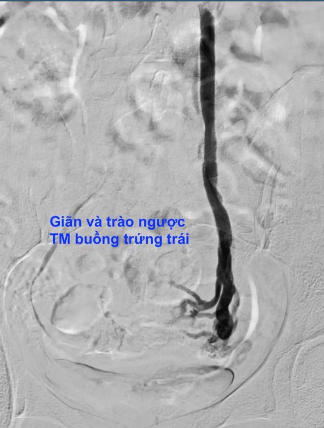 Đau bụng kéo dài hơn 10 năm, người phụ nữ phát hiện căn bệnh ít ai nghĩ tới- Ảnh 2. Đau bụng kéo dài hơn 10 năm, người phụ nữ phát hiện căn bệnh ít ai nghĩ tới- Ảnh 2.