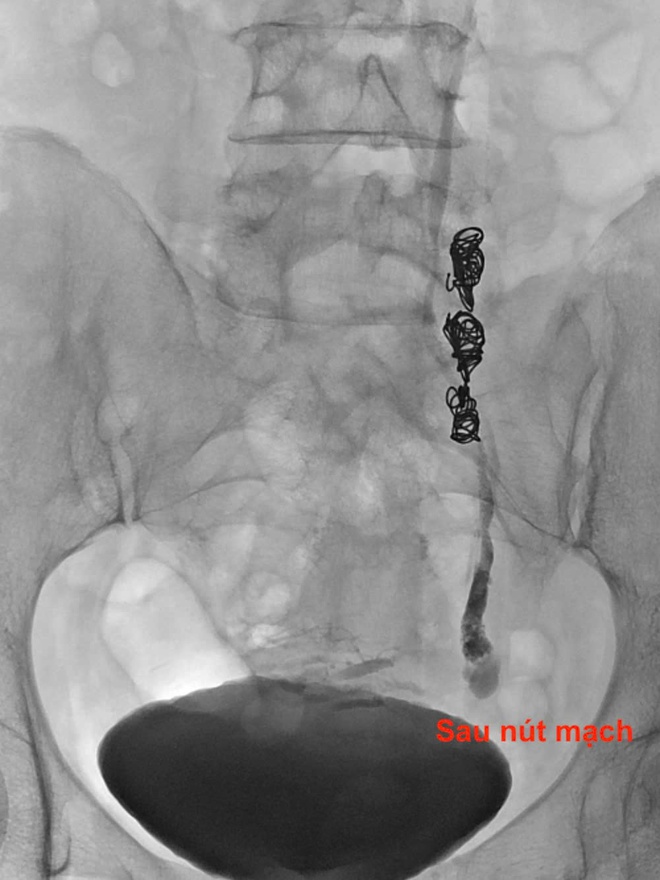 Đau bụng kéo dài hơn 10 năm, người phụ nữ phát hiện căn bệnh ít ai nghĩ tới- Ảnh 4. Đau bụng kéo dài hơn 10 năm, người phụ nữ phát hiện căn bệnh ít ai nghĩ tới- Ảnh 4.