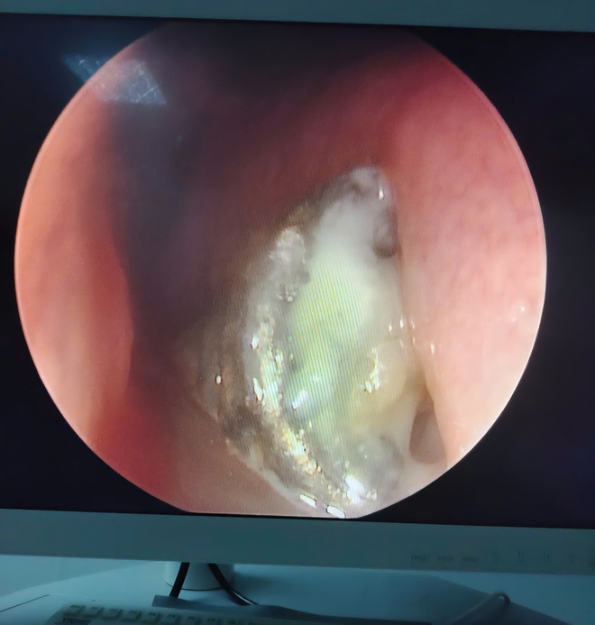 Dị vật pin 'cúc áo', hiểm hoạ khôn lường cho trẻ nhỏ- Ảnh 2.