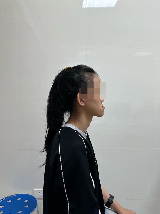 Điều trị móm (khớp cắn ngược) do xương hàm- Ảnh 2. Điều trị móm (khớp cắn ngược) do xương hàm- Ảnh 2.