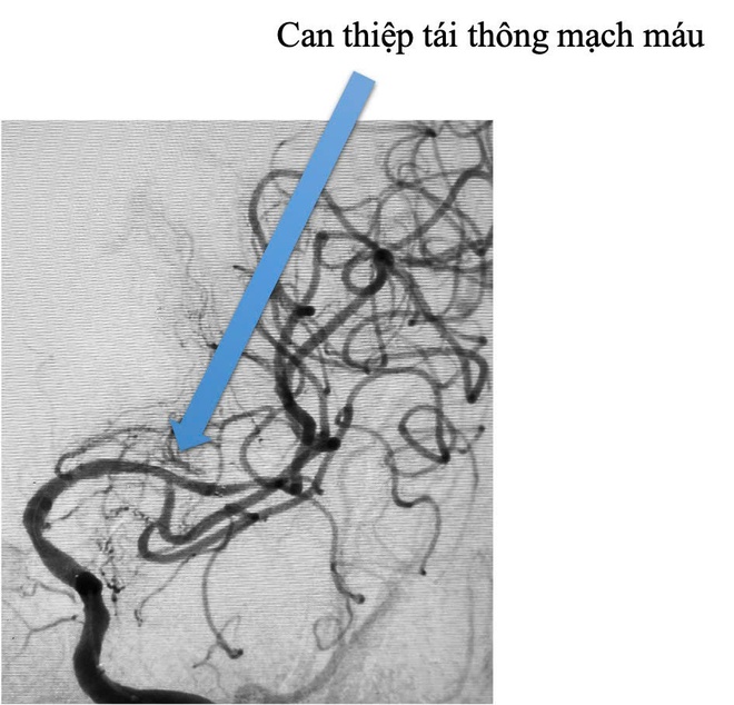 Đột quỵ do xơ vữa động mạch, làm gì để phòng tránh?- Ảnh 2. Đột quỵ do xơ vữa động mạch, làm gì để phòng tránh?- Ảnh 2.