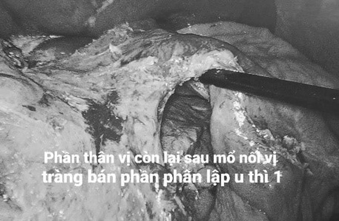 Kỳ tích điều trị đa mô thức cho bệnh nhân ung thư giai đoạn cuối tại Bệnh viện Hữu nghị Đa khoa Nghệ An- Ảnh 4.