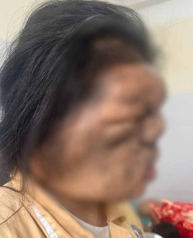 Cô gái 19 tuổi được phẫu thuật sau 17 năm mang khối u khổng lồ vùng mặt- Ảnh 1.