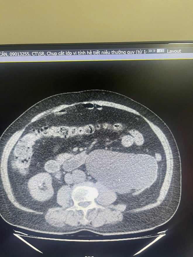 Hai bệnh nhân phải cắt bỏ thận vì ngại đi khám sỏi niệu quản- Ảnh 1. Hai bệnh nhân phải cắt bỏ thận vì ngại đi khám sỏi niệu quản- Ảnh 1.