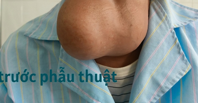 Phẫu thuật thành công bướu tuyến giáp khổng lồ thòng dưới xương đòn- Ảnh 1.